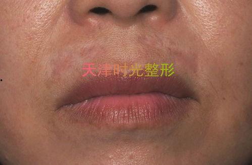 嘴唇疤痕图片,嘴唇疤痕的美丽蜕变之旅